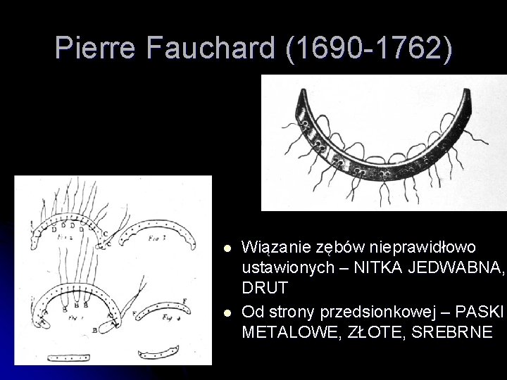 Pierre Fauchard (1690 -1762) l l Wiązanie zębów nieprawidłowo ustawionych – NITKA JEDWABNA, DRUT