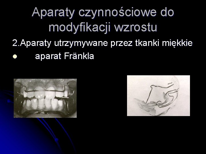 Aparaty czynnościowe do modyfikacji wzrostu 2. Aparaty utrzymywane przez tkanki miękkie l aparat Fränkla