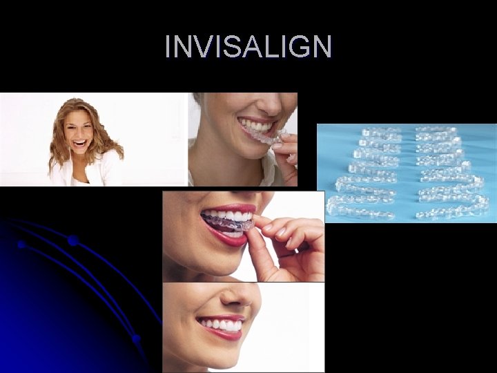 INVISALIGN 