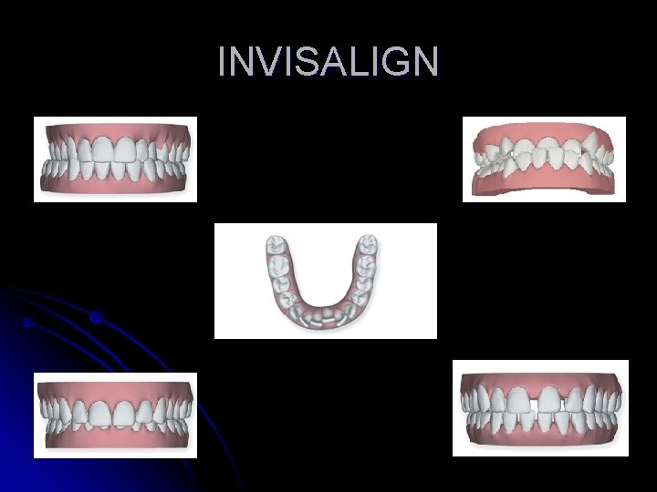 INVISALIGN 