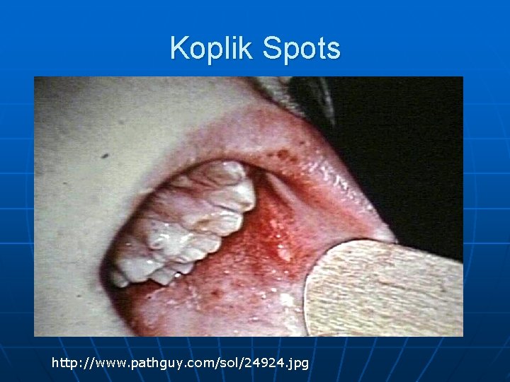 Koplik Spots http: //www. pathguy. com/sol/24924. jpg 