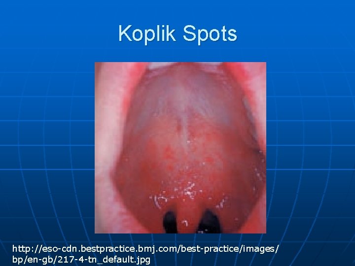 Koplik Spots http: //eso-cdn. bestpractice. bmj. com/best-practice/images/ bp/en-gb/217 -4 -tn_default. jpg 