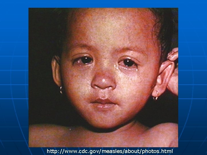 http: //www. cdc. gov/measles/about/photos. html 