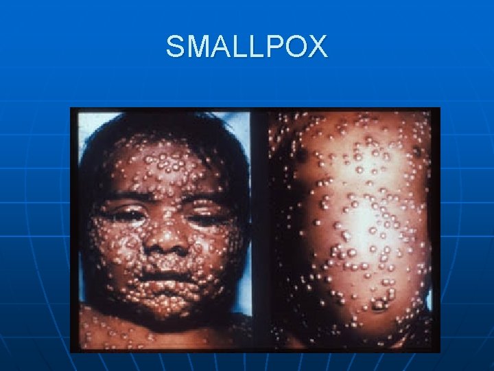 SMALLPOX 