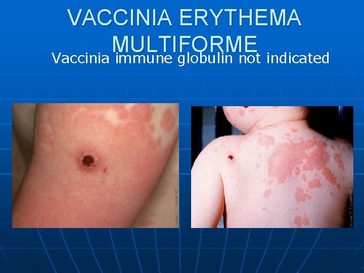 VACCINIA ERYTHEMA MULTIFORME Vaccinia immune globulin not indicated 