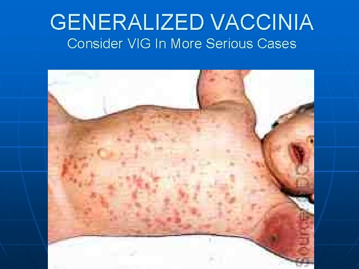GENERALIZED VACCINIA Consider VIG In More Serious Cases 