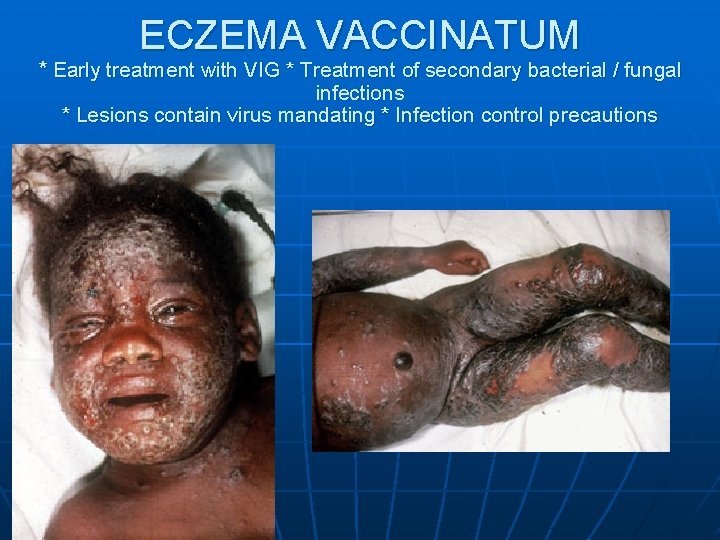 ECZEMA VACCINATUM * Early treatment with VIG * Treatment of secondary bacterial / fungal