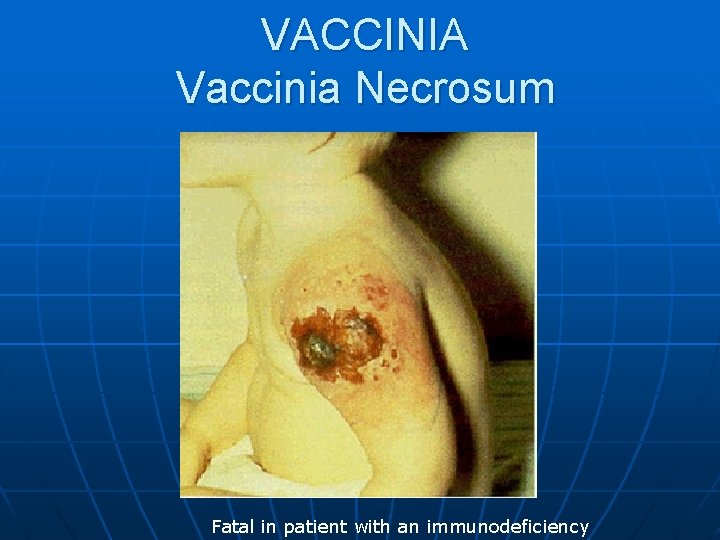 VACCINIA Vaccinia Necrosum Fatal in patient with an immunodeficiency 