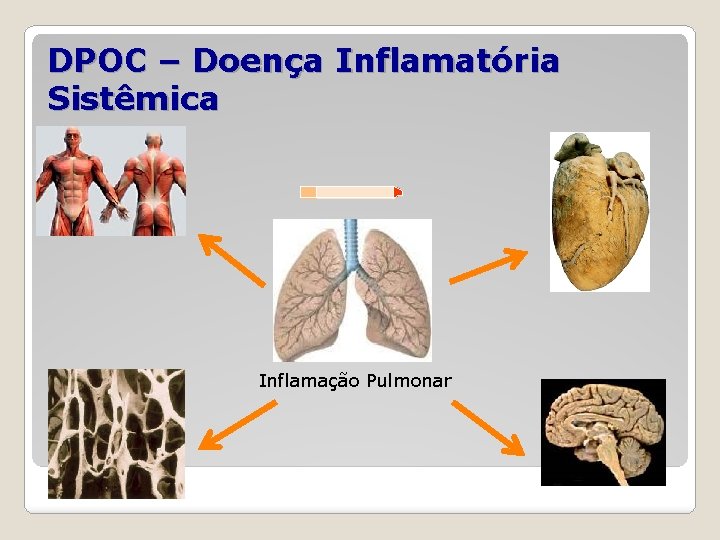DPOC – Doença Inflamatória Sistêmica Inflamação Pulmonar 