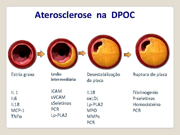 Aterosclerose na DPOC Estria graxa Lesão intermediária Desestabilização da placa Ruptura de placa IL