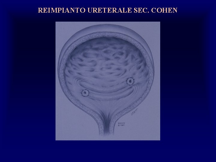 REIMPIANTO URETERALE SEC. COHEN 