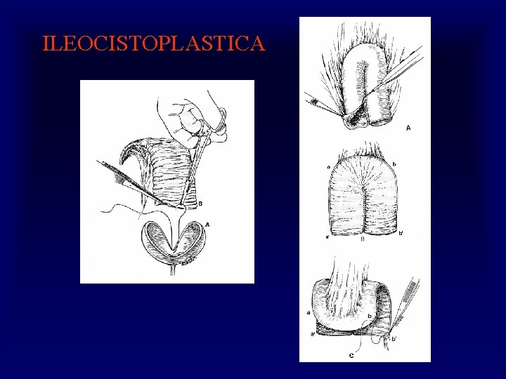 ILEOCISTOPLASTICA 