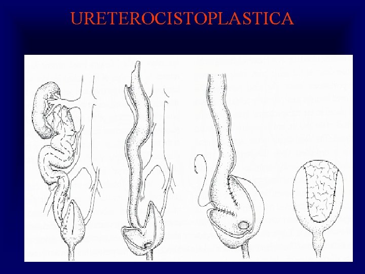 URETEROCISTOPLASTICA 