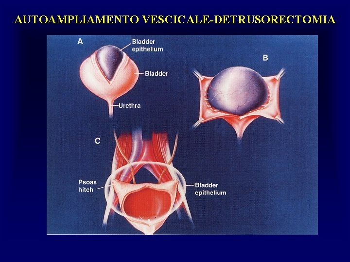 AUTOAMPLIAMENTO VESCICALE-DETRUSORECTOMIA 