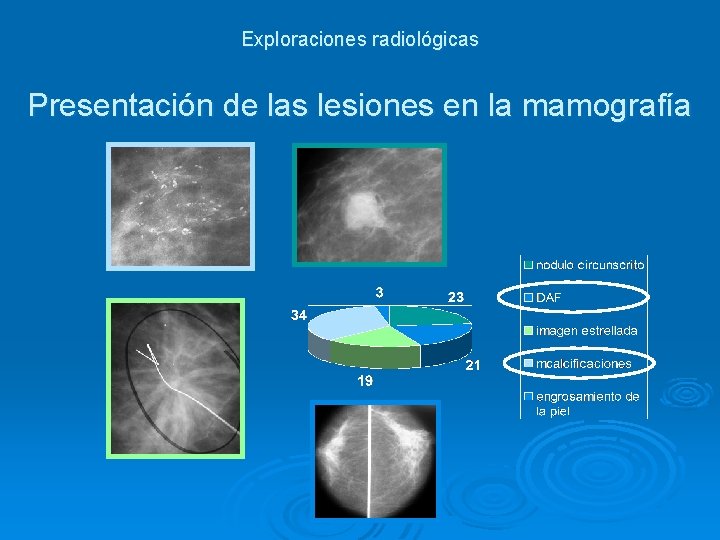 Exploraciones radiológicas Presentación de las lesiones en la mamografía 