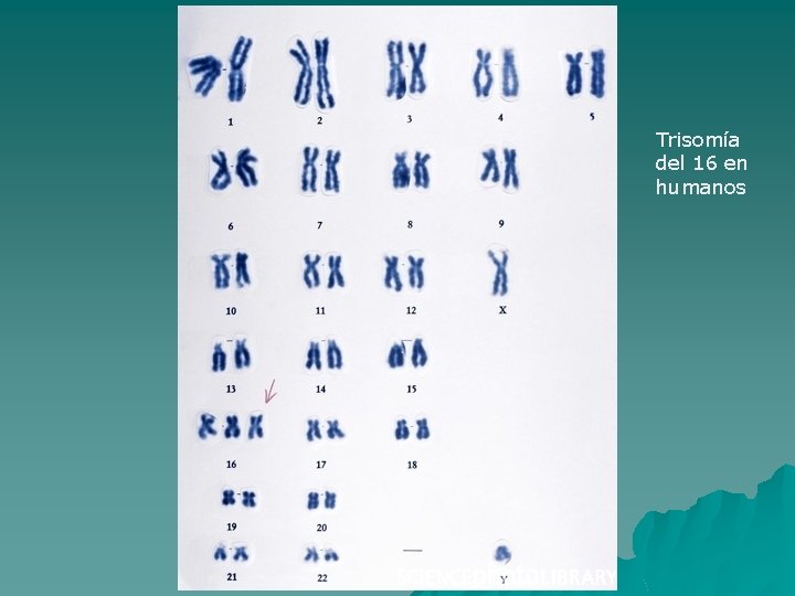 Trisomía del 16 en humanos 