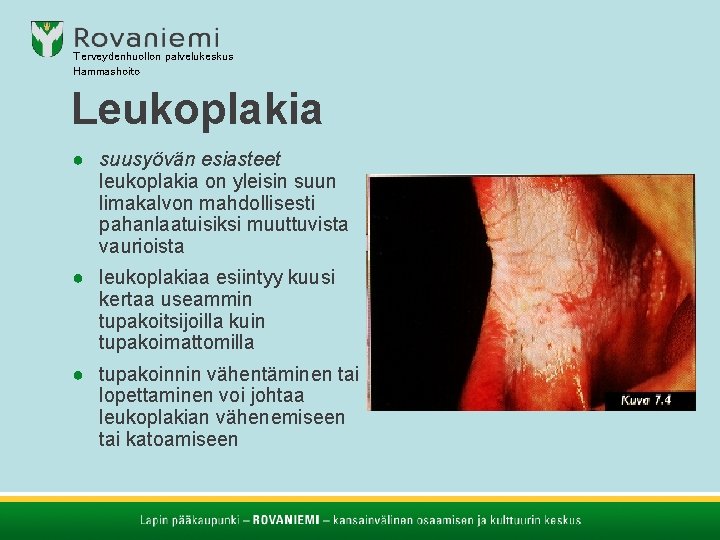 Terveydenhuollon palvelukeskus Hammashoito Leukoplakia ● suusyövän esiasteet leukoplakia on yleisin suun limakalvon mahdollisesti pahanlaatuisiksi