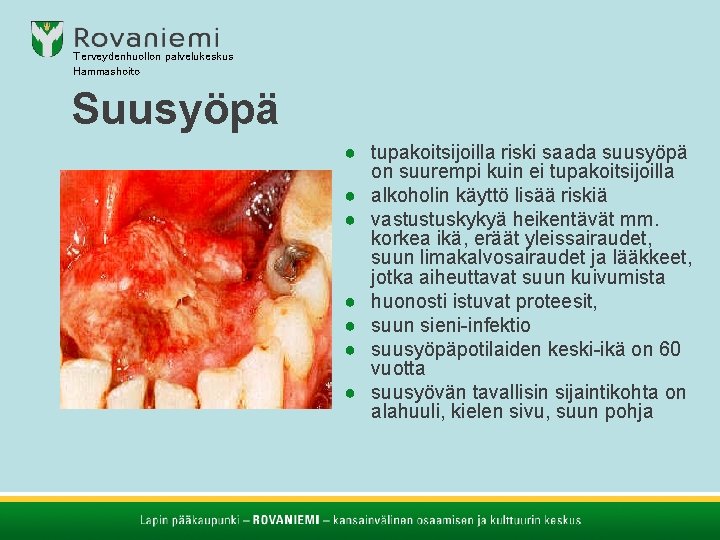 Terveydenhuollon palvelukeskus Hammashoito Suusyöpä ● tupakoitsijoilla riski saada suusyöpä on suurempi kuin ei tupakoitsijoilla