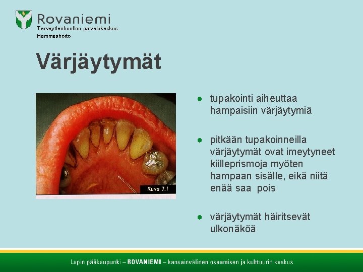 Terveydenhuollon palvelukeskus Hammashoito Värjäytymät ● tupakointi aiheuttaa hampaisiin värjäytymiä ● pitkään tupakoinneilla värjäytymät ovat