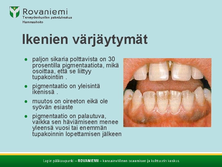 Terveydenhuollon palvelukeskus Hammashoito Ikenien värjäytymät ● paljon sikaria polttavista on 30 prosentilla pigmentaatiota, mikä Terveydenhuollon palvelukeskus Hammashoito Ikenien värjäytymät ● paljon sikaria polttavista on 30 prosentilla pigmentaatiota, mikä