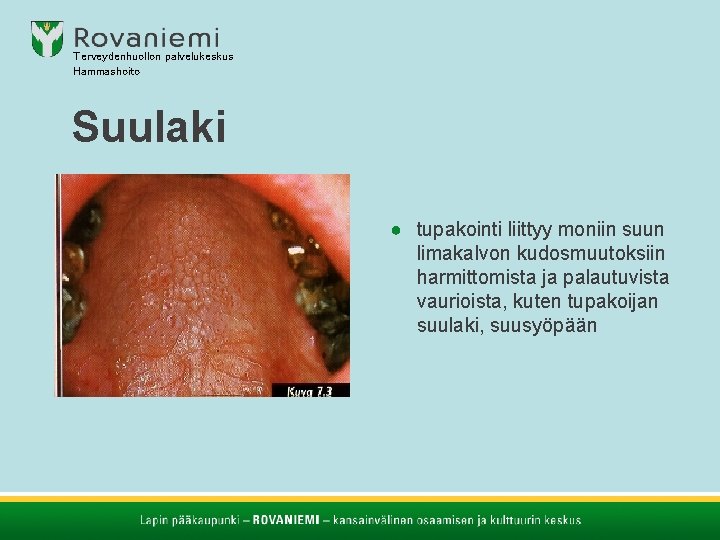 Terveydenhuollon palvelukeskus Hammashoito Suulaki ● tupakointi liittyy moniin suun limakalvon kudosmuutoksiin harmittomista ja palautuvista