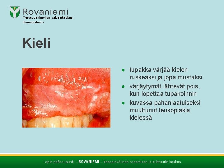 Terveydenhuollon palvelukeskus Hammashoito Kieli ● tupakka värjää kielen ruskeaksi ja jopa mustaksi ● värjäytymät