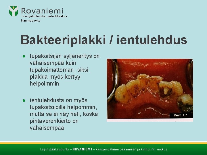 Terveydenhuollon palvelukeskus Hammashoito Bakteeriplakki / ientulehdus ● tupakoitsijan syljeneritys on vähäisempää kuin tupakoimattoman, siksi