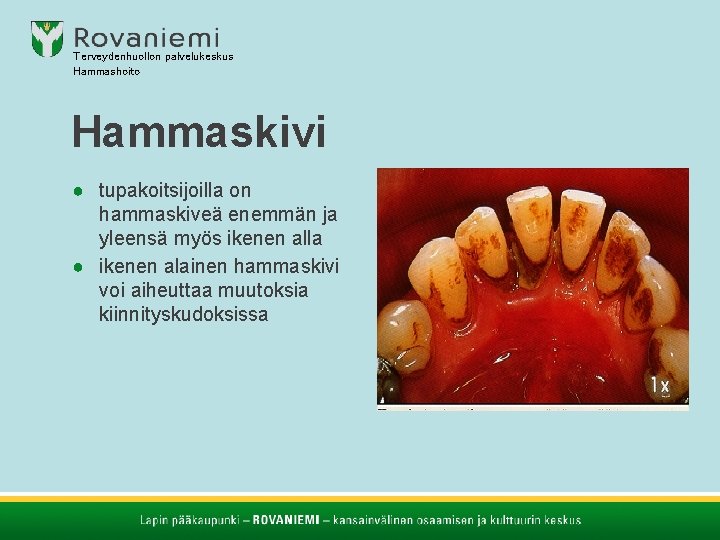 Terveydenhuollon palvelukeskus Hammashoito Hammaskivi ● tupakoitsijoilla on hammaskiveä enemmän ja yleensä myös ikenen alla