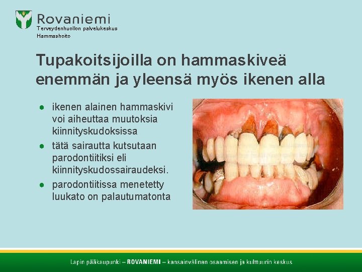 Terveydenhuollon palvelukeskus Hammashoito Tupakoitsijoilla on hammaskiveä enemmän ja yleensä myös ikenen alla ● ikenen Terveydenhuollon palvelukeskus Hammashoito Tupakoitsijoilla on hammaskiveä enemmän ja yleensä myös ikenen alla ● ikenen