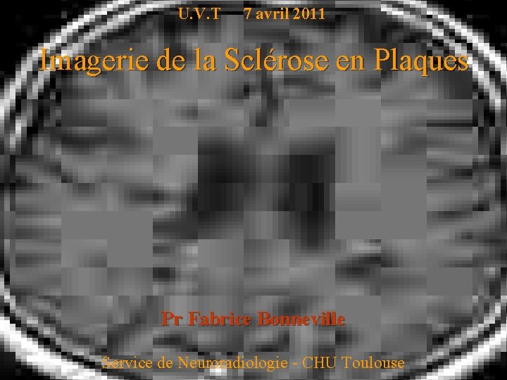 U. V. T 7 avril 2011 Imagerie de la Sclérose en Plaques Pr Fabrice