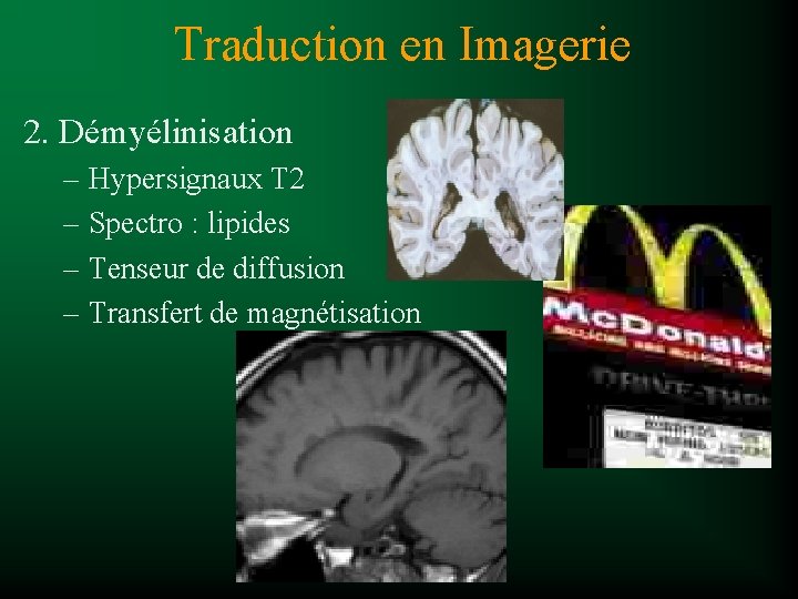 Traduction en Imagerie 2. Démyélinisation – Hypersignaux T 2 – Spectro : lipides –