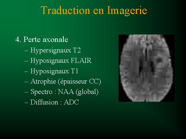 Traduction en Imagerie 4. Perte axonale – Hypersignaux T 2 – Hyposignaux FLAIR –