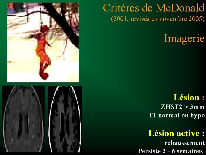 Critères de Mc. Donald (2001, révisés en novembre 2005) Imagerie Lésion : ZHST 2