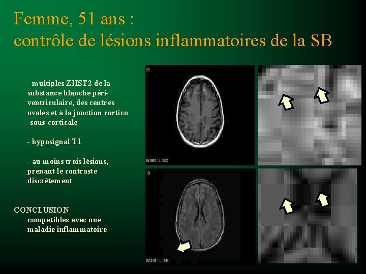 Femme, 51 ans : contrôle de lésions inflammatoires de la SB - multiples ZHST