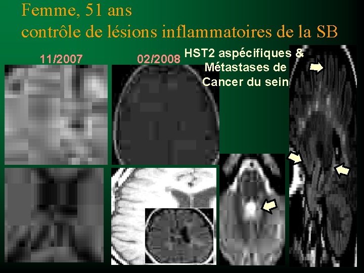 Femme, 51 ans contrôle de lésions inflammatoires de la SB 11/2007 02/2008 HST 2