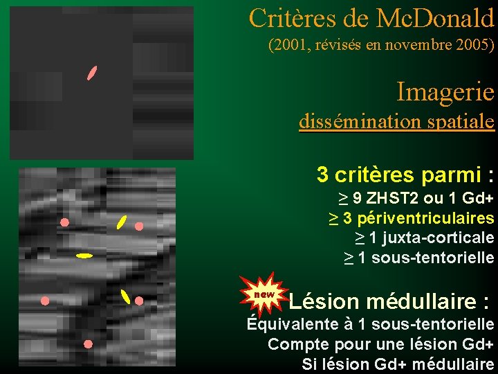 Critères de Mc. Donald (2001, révisés en novembre 2005) Imagerie dissémination spatiale 3 critères