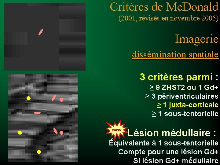Critères de Mc. Donald (2001, révisés en novembre 2005) Imagerie dissémination spatiale 3 critères
