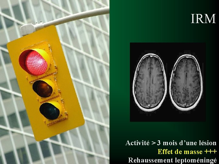 IRM Activité > 3 mois d’une lésion Effet de masse +++ Rehaussement leptoméningé 