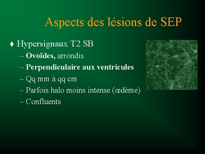 Aspects des lésions de SEP t Hypersignaux T 2 SB – Ovoïdes, arrondis –