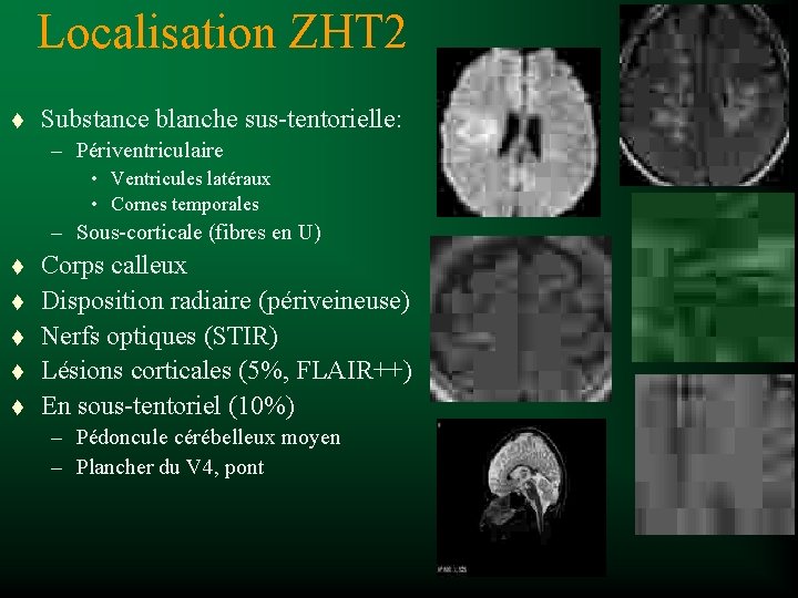 Localisation ZHT 2 t Substance blanche sus-tentorielle: – Périventriculaire • Ventricules latéraux • Cornes
