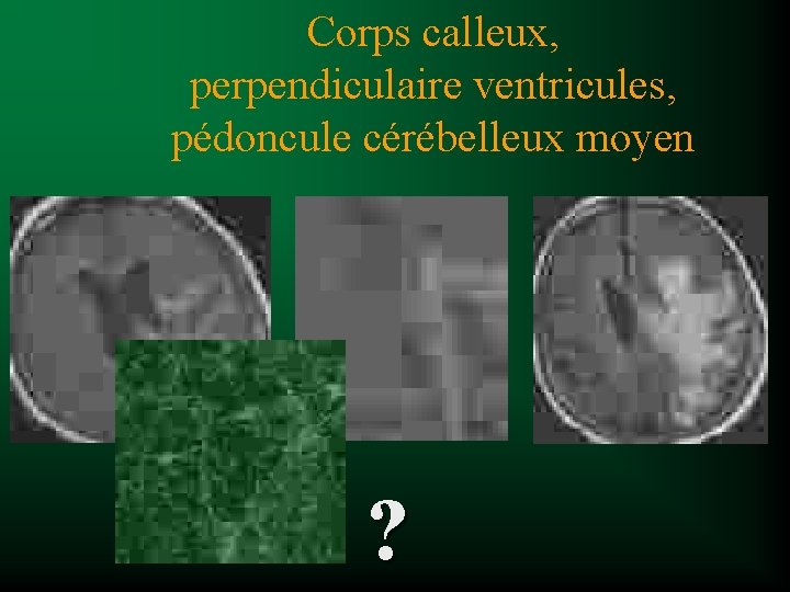 Corps calleux, perpendiculaire ventricules, pédoncule cérébelleux moyen ? 