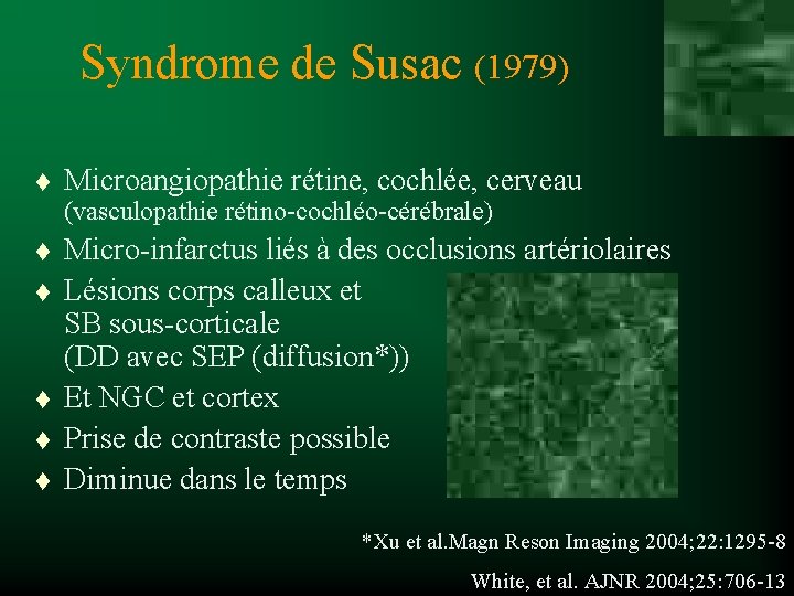 Syndrome de Susac (1979) t Microangiopathie rétine, cochlée, cerveau (vasculopathie rétino-cochléo-cérébrale) t t t