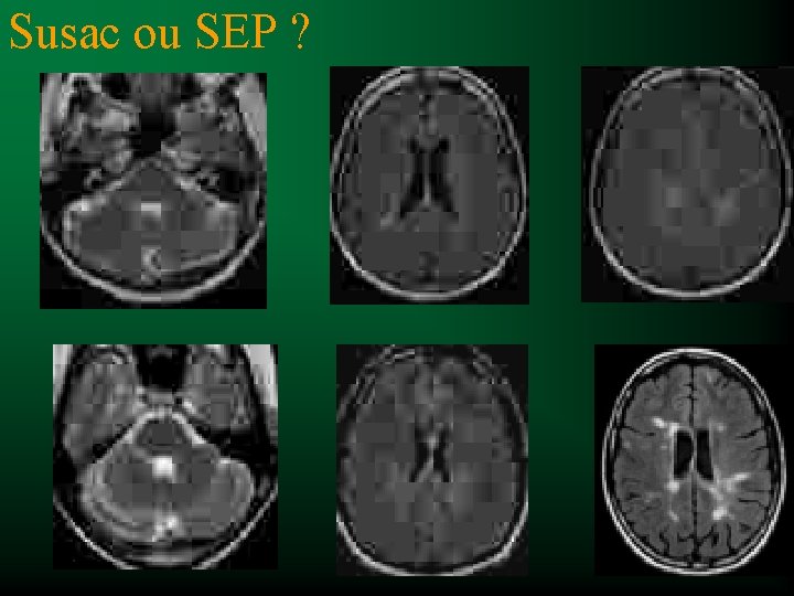 Susac ou SEP ? 