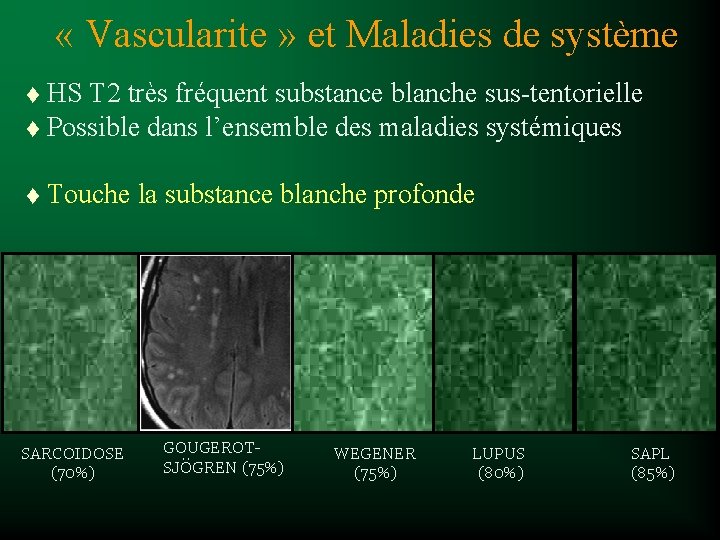  « Vascularite » et Maladies de système HS T 2 très fréquent substance