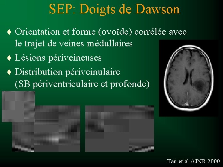 SEP: Doigts de Dawson t t t Orientation et forme (ovoïde) corrélée avec le
