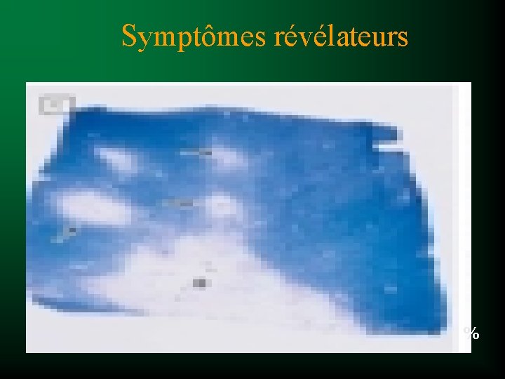 Symptômes révélateurs % 