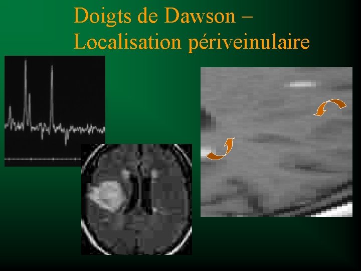 Doigts de Dawson – Localisation périveinulaire 