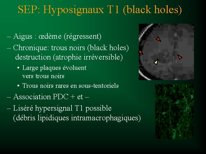 SEP: Hyposignaux T 1 (black holes) – Aigus : œdème (régressent) – Chronique: trous