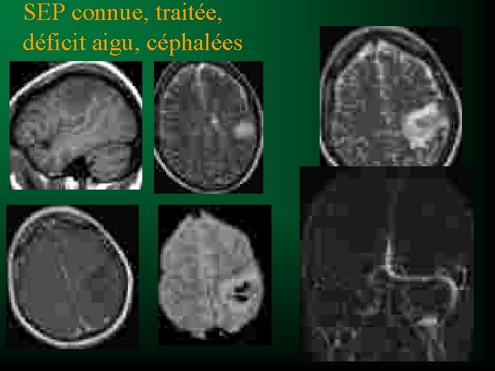 SEP connue, traitée, déficit aigu, céphalées 