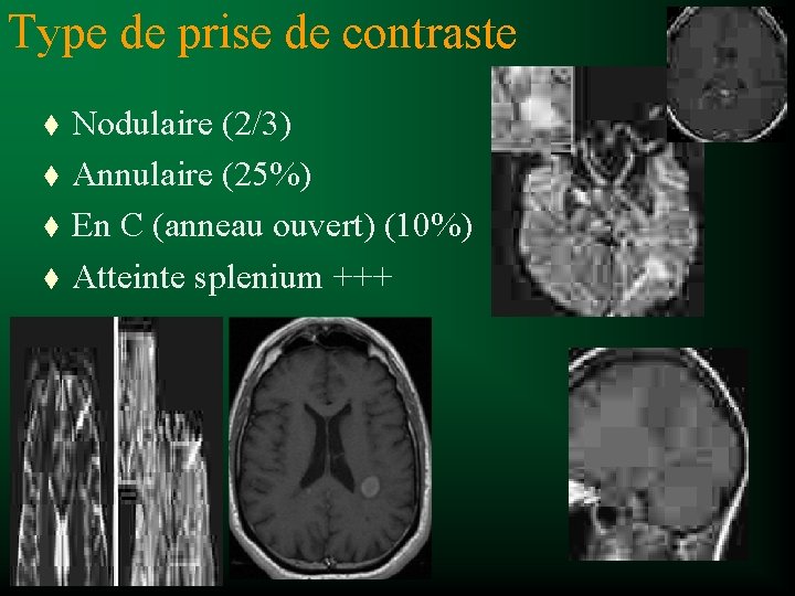 Type de prise de contraste t t Nodulaire (2/3) Annulaire (25%) En C (anneau